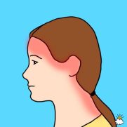 Tension headache