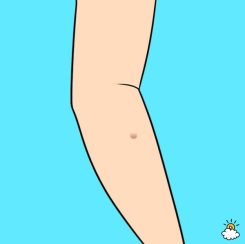 What Is A Skin Tag?