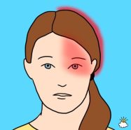 Migrainee