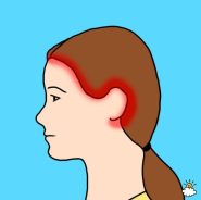 Temporal headache