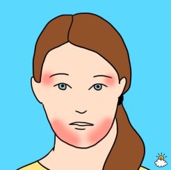 Temporomandibular joint ache